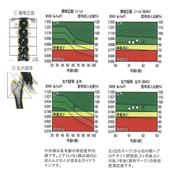 62岁受试者服用蛋白钛1年期间的骨密度变化.png