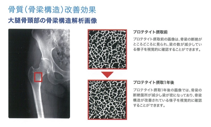 股骨颈的骨梁结构解析图像.png