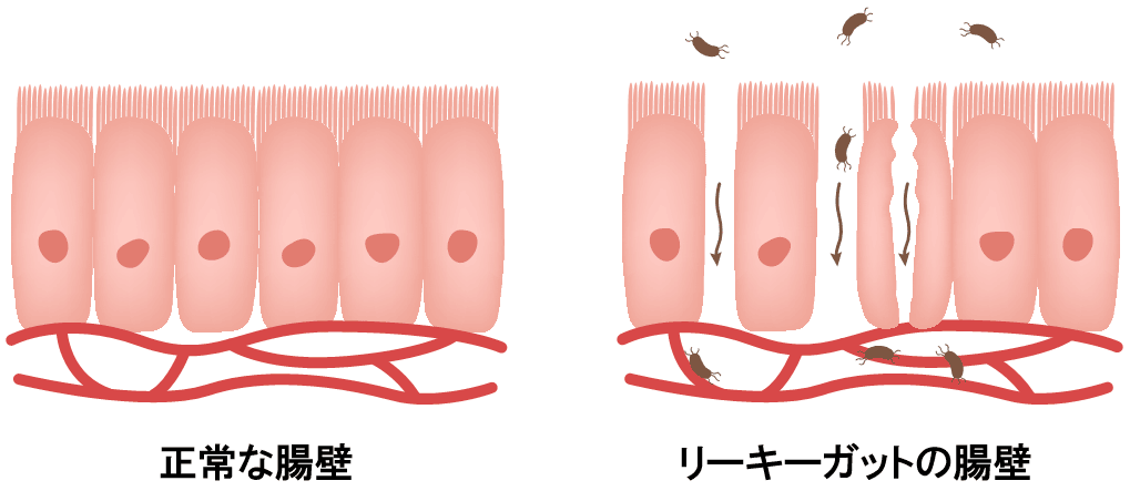 肠道菌群紊乱引起肠漏.gif